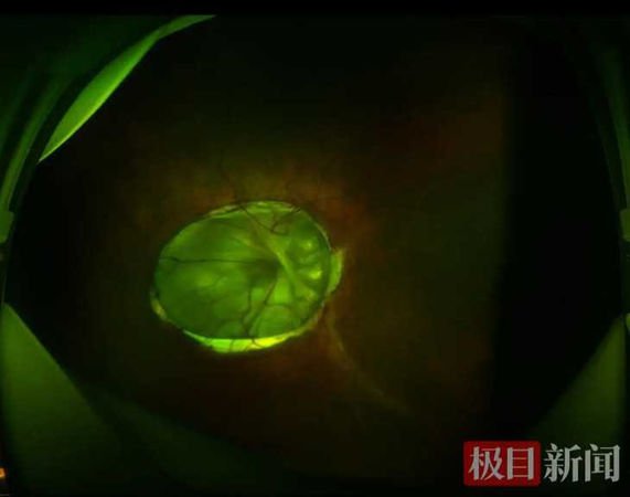 活了38年... 武汉女视力超差「看手机都不清楚」 检查竟是眼里长牵牛花
