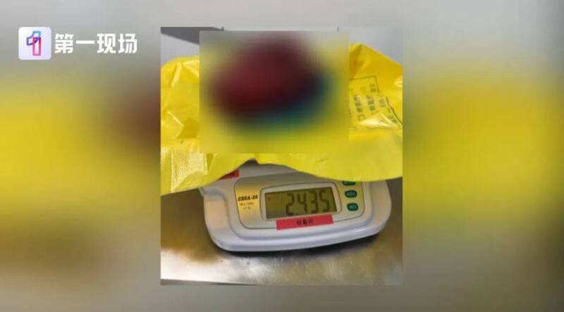 中国广东省17岁少女「婷婷」身形消瘦、肚子却大得不正常,就医查出右肾肿瘤大到占据整个腹腔,经手术取出,直径竟达27公分,重2.435公斤。(撷取自《第一现场》影片画面) 中国广东省17岁少女「婷婷」身形消瘦、肚子却大得不正常,就医查出右肾肿瘤大到占据整个腹腔,经手术取出,直径竟达27公分,重2.435公斤。(撷取自《第一现场》影片画面)