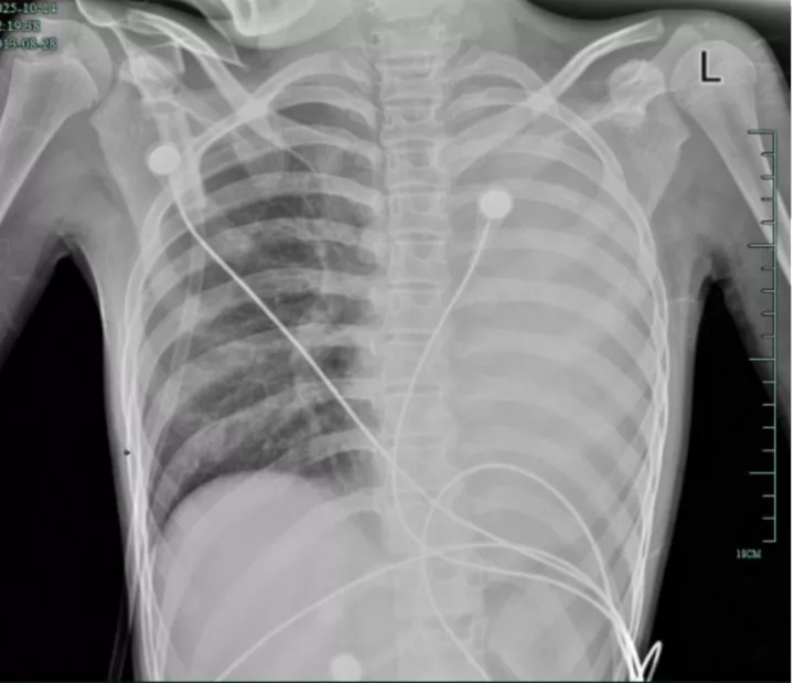 12岁女孩发热1天肺全白!这种会堵死气道的病,别当普通感冒