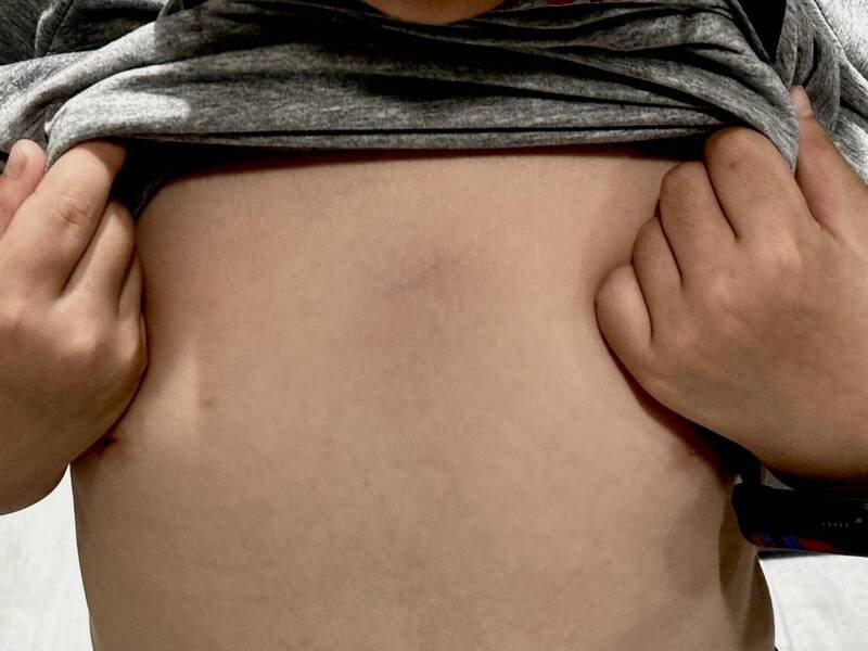 年仅6岁的钟姓学童疑似遭老师「肘击」心窝，胸口瘀青吓坏家长。（记者王姝琇翻摄）