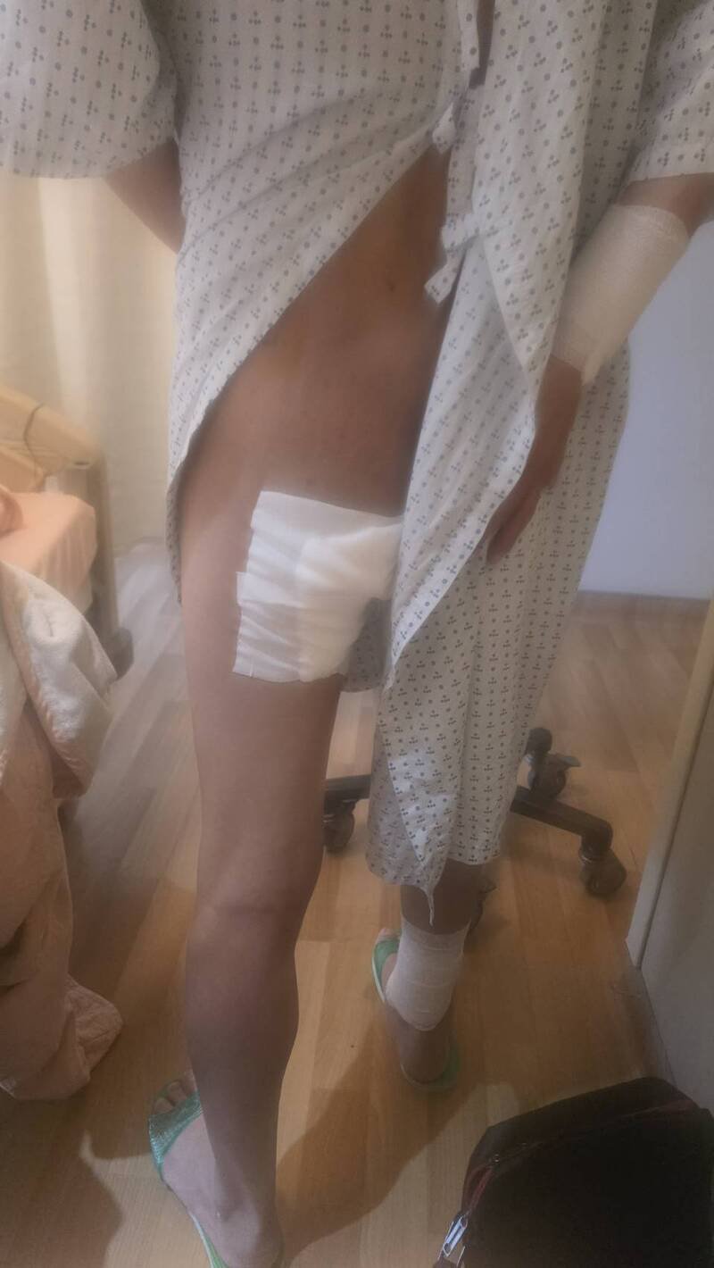 曾姓保全员昨在板桥一处加油站遭歹徒自淋点火后扑倒灼伤，他今天出示伤势及受访。（记者吴仁捷翻摄）