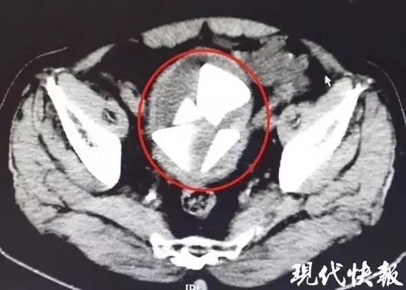 男子体内取出金字塔状结石，医生：非常罕见