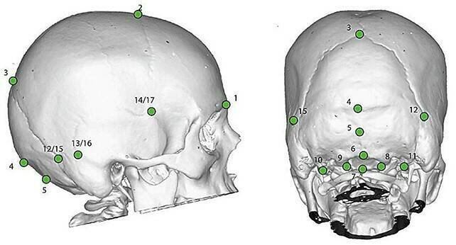 研究团队以3D模型比对现代与古代头骨形状,发现患有小脑扁桃体下疝畸形的现代人,其头骨特征与尼安德塔人高度相似,显示遗传连结可能是偏头痛的远古根源。图为研究中所标记的头骨比对点。(图:《Evolution, Medicine and Public Health》期刊) 研究团队以3D模型比对现代与古代头骨形状,发现患有小脑扁桃体下疝畸形的现代人,其头骨特征与尼安德塔人高度相似,显示遗传连结可能是偏头痛的远古根源。图为研究中所标记的头骨比对点。(图:《Evolution, Medicine and Public Health》期刊)