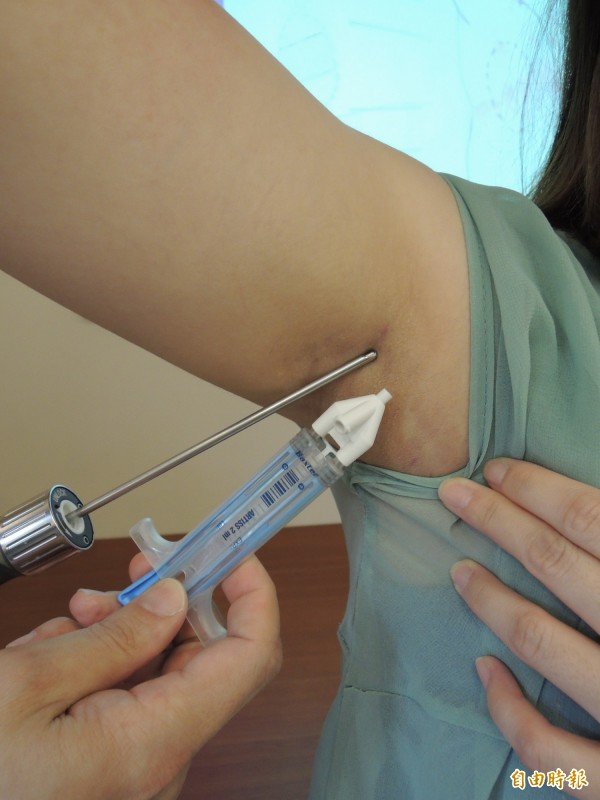 女子抽脂险丢小命，但五次鉴定确认无医疗疏失。（抽脂手术示意图，记者蔡淑媛摄）